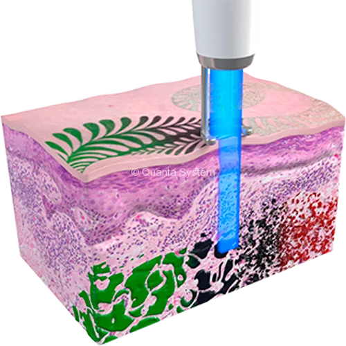 QPlus Tatuaggi 1064 1 - לי דניאלס