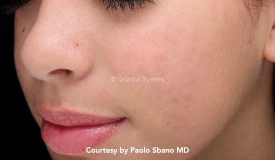 q plus acne post - לי דניאלס