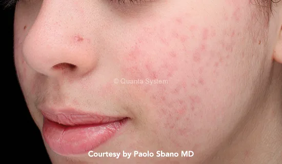 q-plus-acne-pre q plus acne pre - לי דניאלס